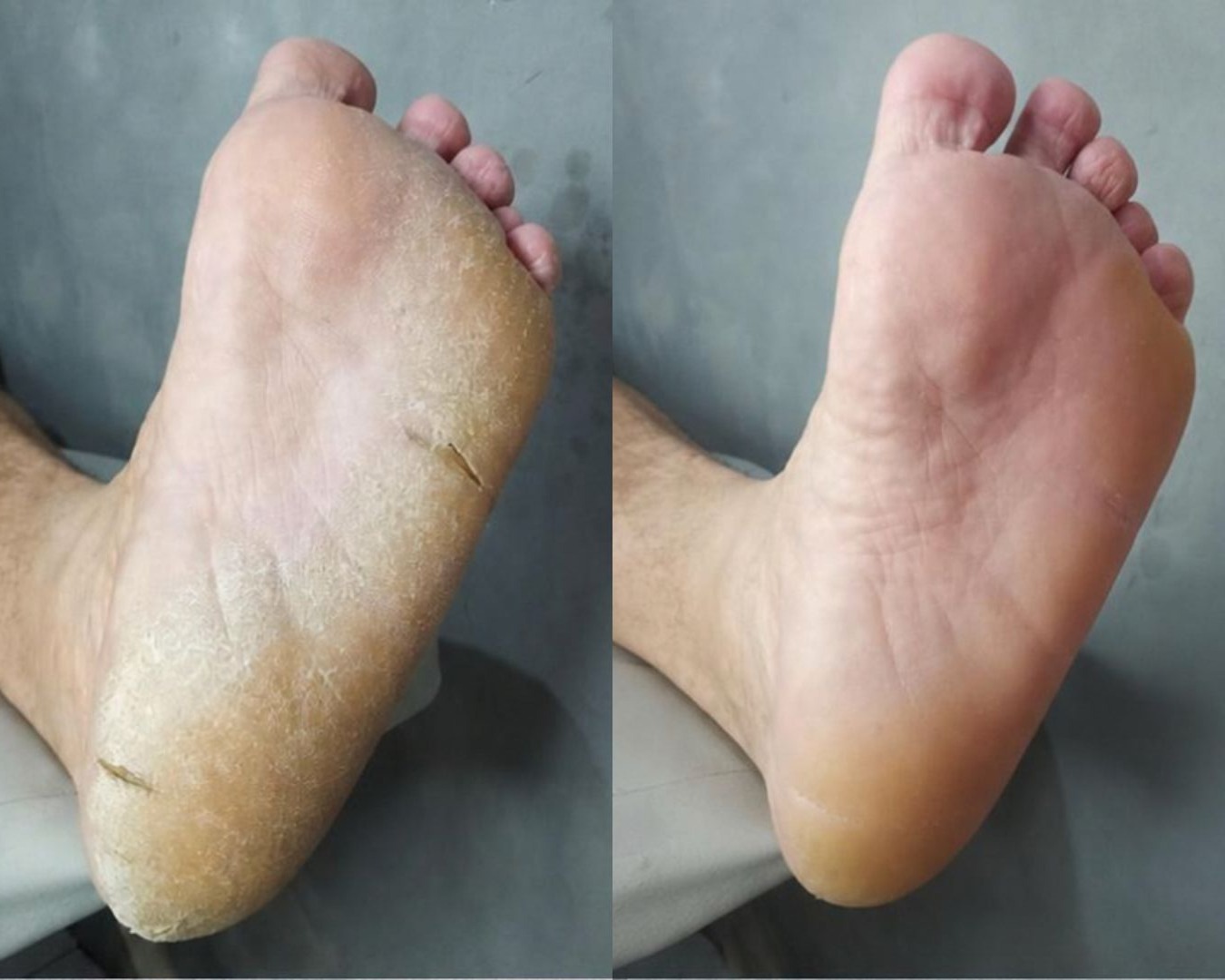 Antes e depois — tratamento de rachaduras e calosidades no calcanhar