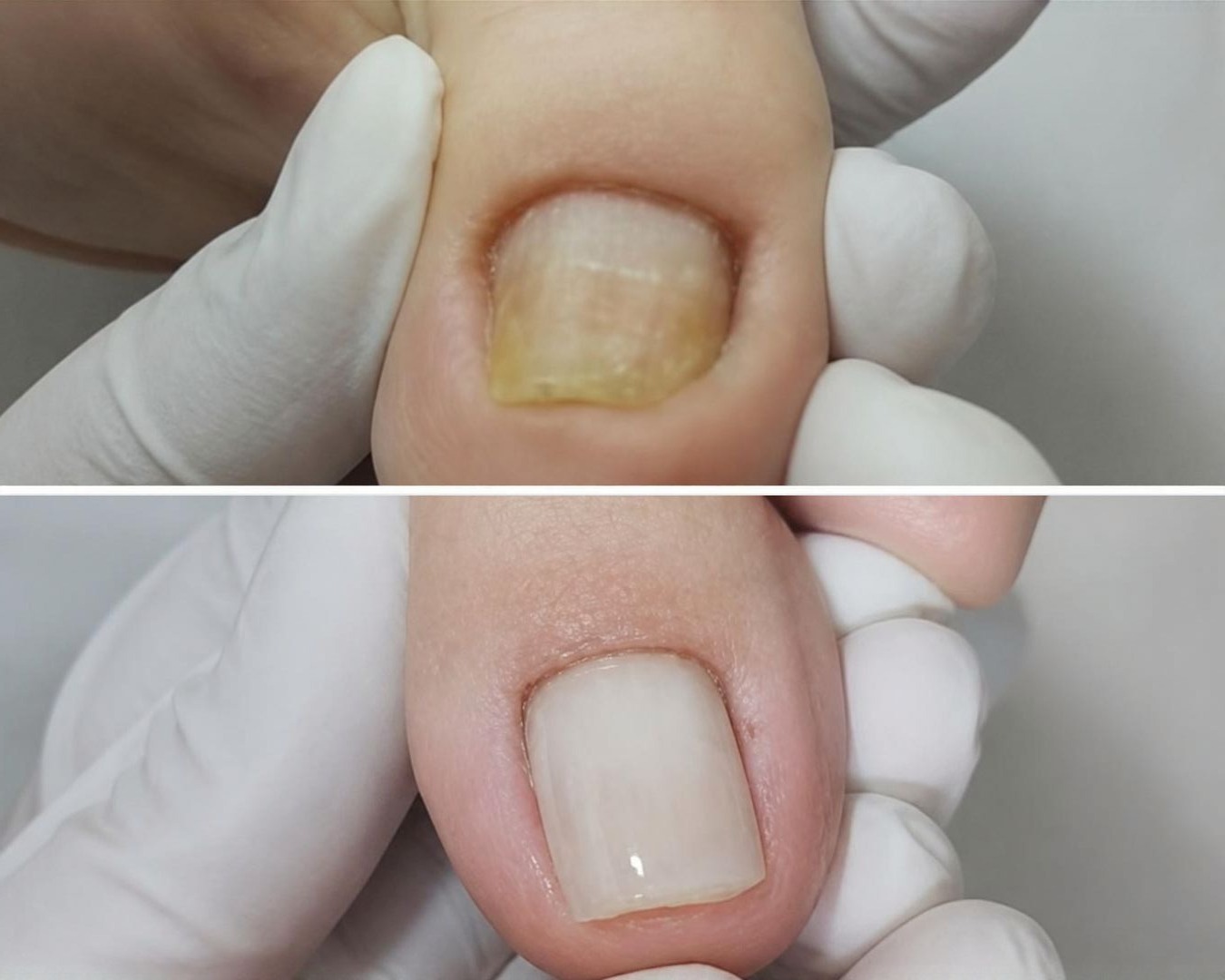 Antes e depois — tratamento podológico de unha