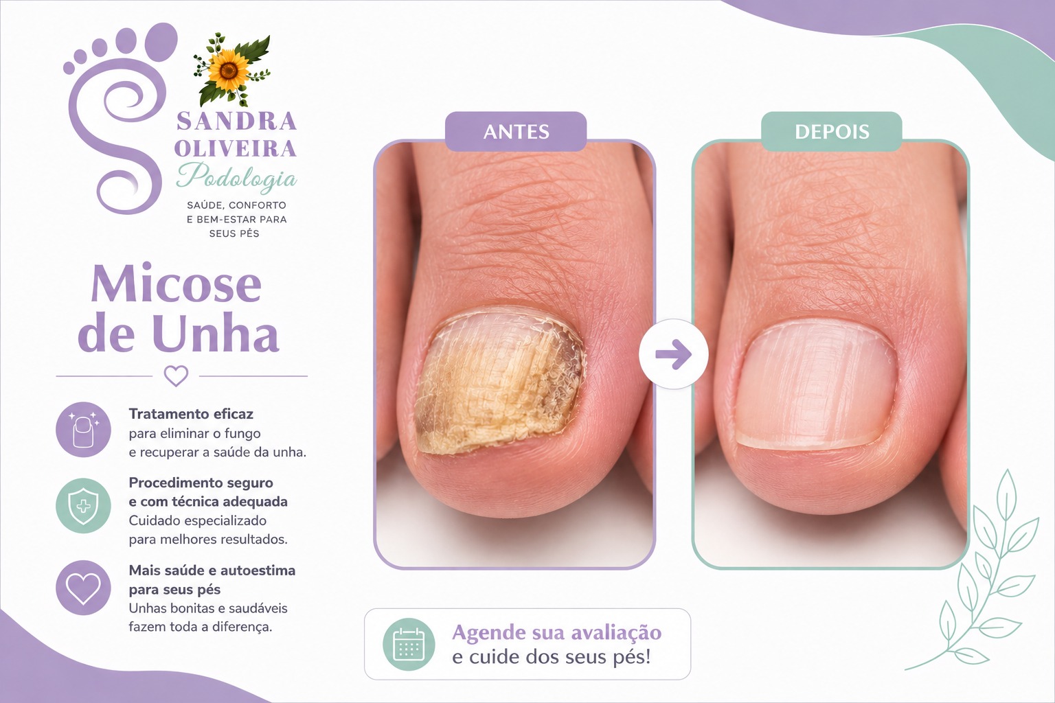 Tratamento de micose de unha — podologia clínica