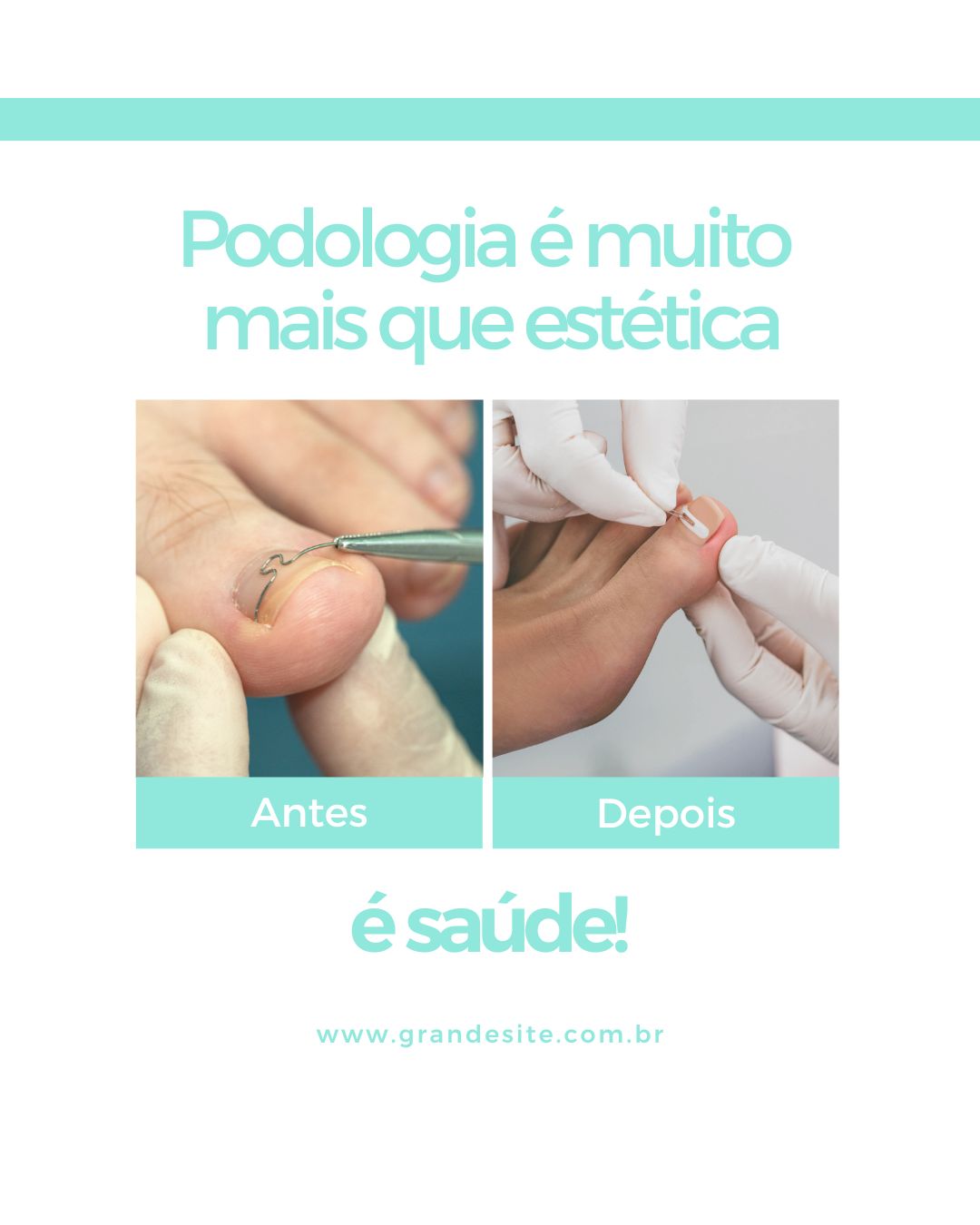 Antes e depois com órtese ungueal de fibra