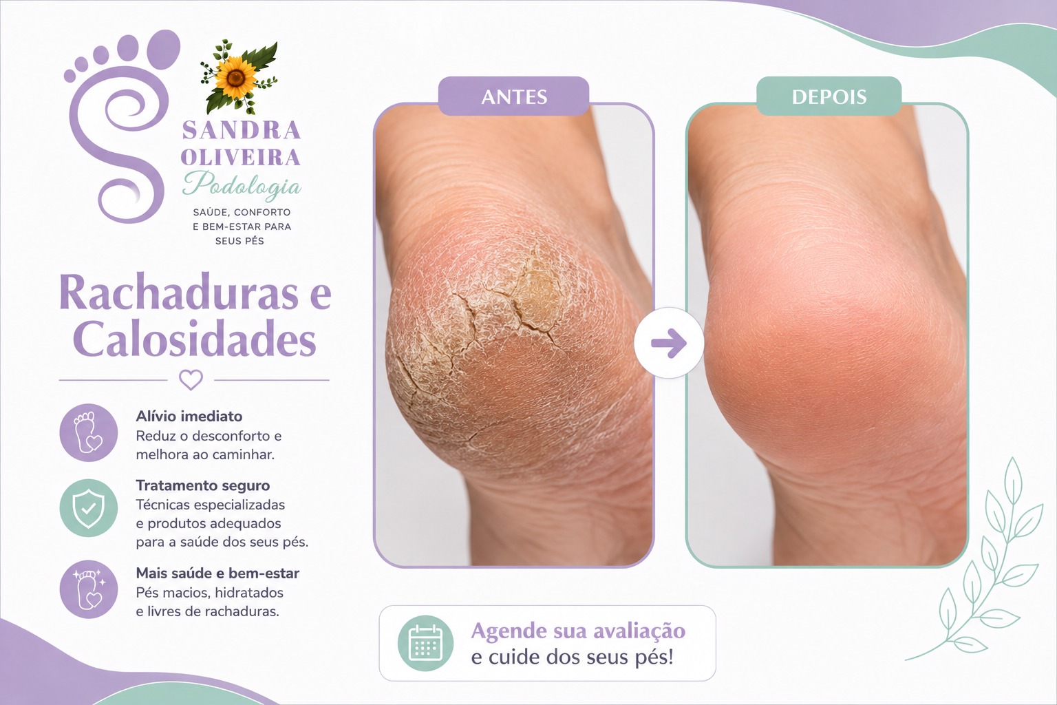 Tratamento de rachaduras e calos nos pés