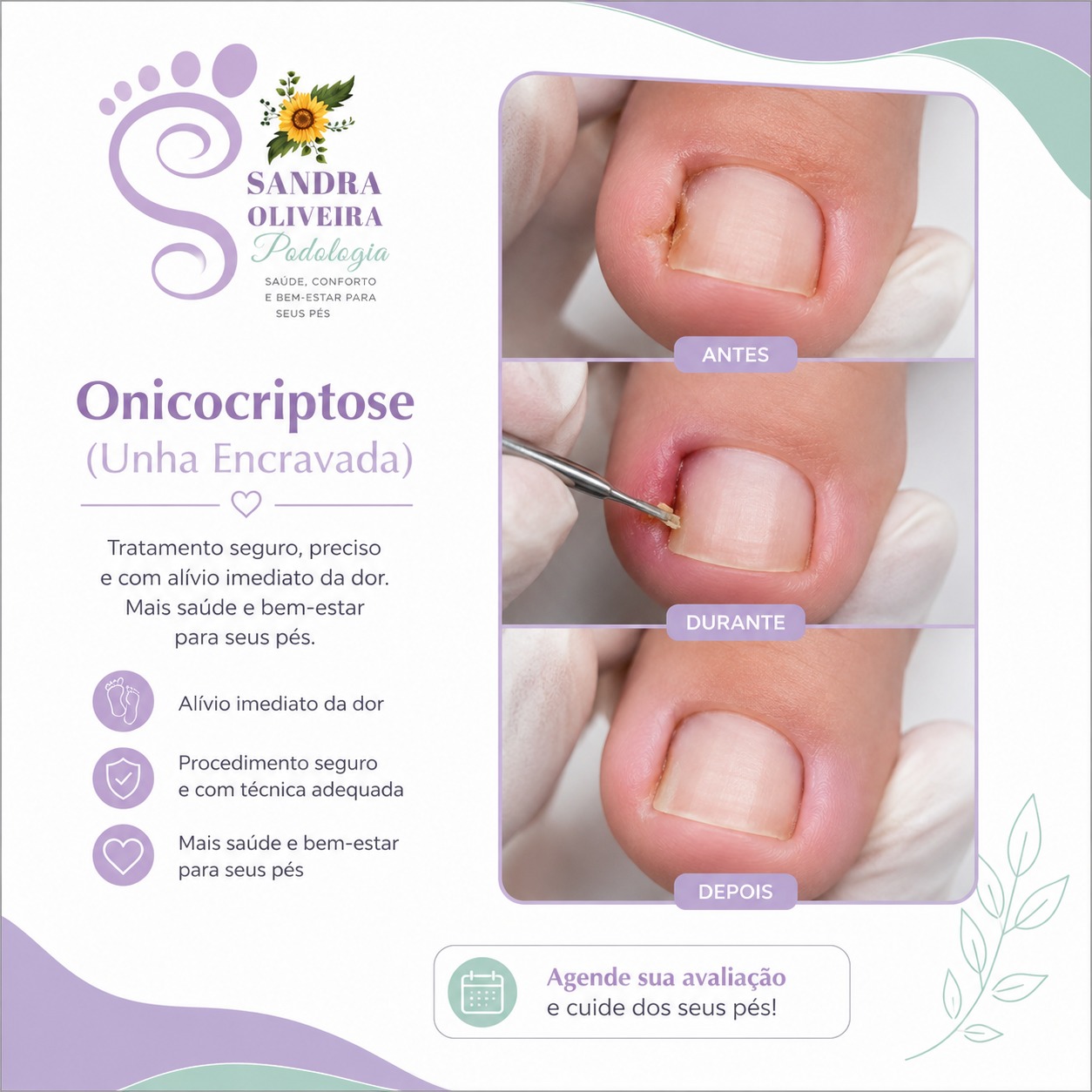 Card informativo do tratamento de Onicocriptose e alívio da dor